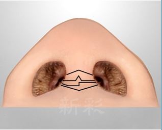 韓式隆鼻手術鼻柱切口
