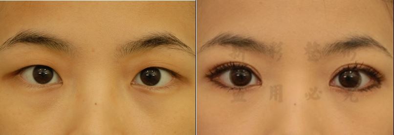 新彩整型外科診所隱痕8字形縫雙眼皮手術前後比較