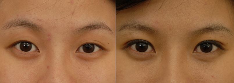 新彩整型外科診所隱痕8字形縫雙眼皮手術前後比較